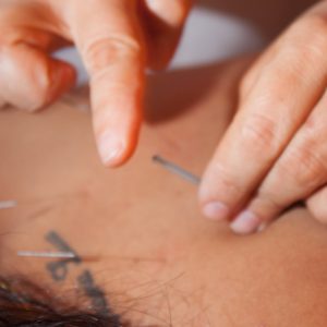 Acupuntura